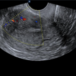Ecografia transvaginal