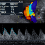Ecografía doppler del II trimestre (22-26 semanas)