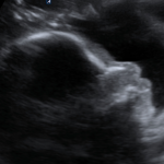 Ecografía obstetrica 2D 