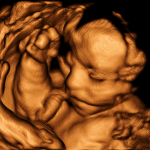 Ecografia obstetrica 3D - 4D